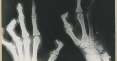 X-ray of a case of leprosy (National Museum of Health and Medicine/Flickr/CC BY 2.0)