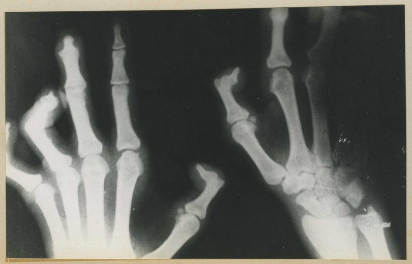 X-ray of a case of leprosy (National Museum of Health and Medicine/Flickr/CC BY 2.0)